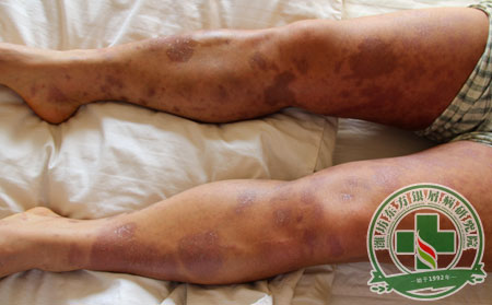 銀屑病護(hù)理