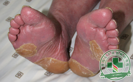 紅皮型銀屑病的皮膚表現(xiàn)