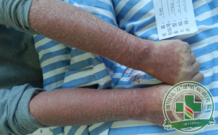 銀屑病治療的一些基本注意事項