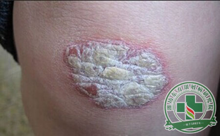 是什么導(dǎo)致了銀屑病病情惡化不止 