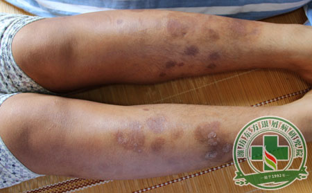 銀屑病治療