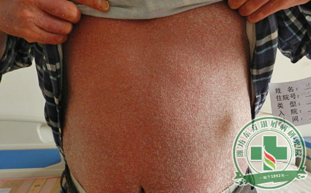 銀屑病的治療方法共有幾種類別