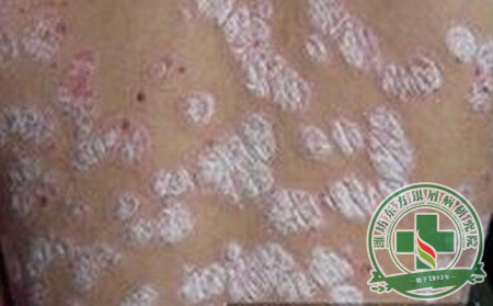 屑病病情不斷蔓延怎么控制？ 