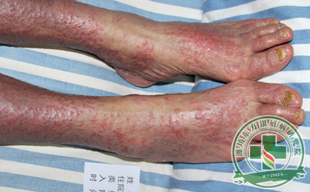 銀屑病治療