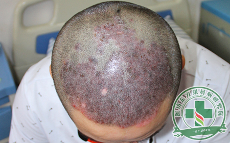 頭皮銀屑病