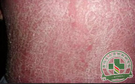 輕度銀屑病怎么還是會復(fù)發(fā)？  