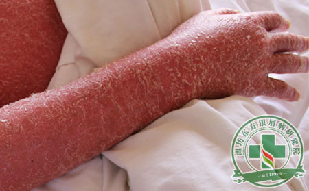 紅皮病型銀屑病護理