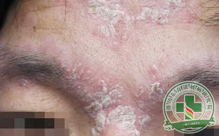 面部銀屑病患者的具體癥狀是什么樣