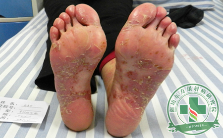 銀屑病病因可能會由什么原因產生