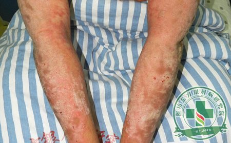 尋常型銀屑病護理