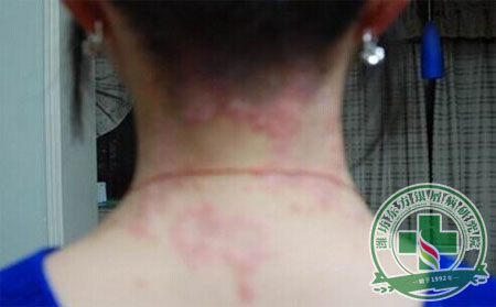 潛伏：女性銀屑病患者的減壽殺手   