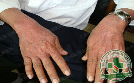 銀屑病南北差異是生活習性所致嗎？