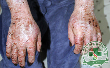 關節型銀屑病癥狀居然可累及指甲