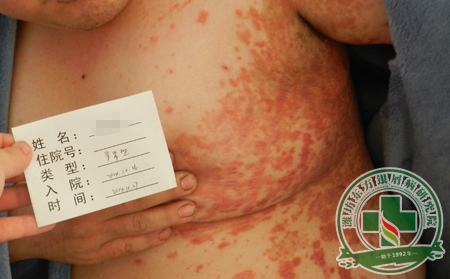 尋常型銀屑病的具體癥狀特征