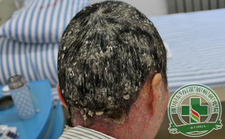 有多少人知道尋常型銀屑病的診斷方法