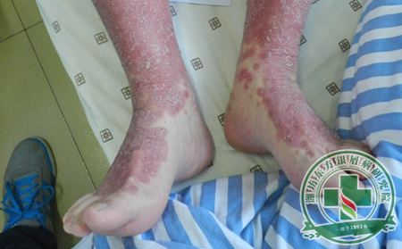 如何提高關節型銀屑病患者的護理水平