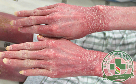 關(guān)節(jié)型銀屑病