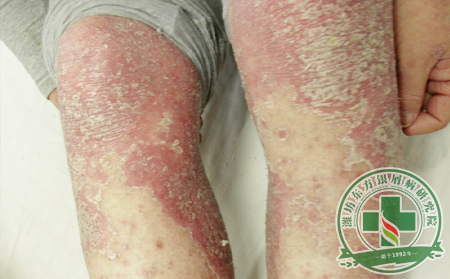 銀屑病治療