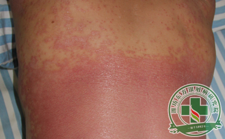銀屑病治療