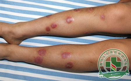 牛皮癬治療