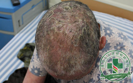 頭部銀屑病治療