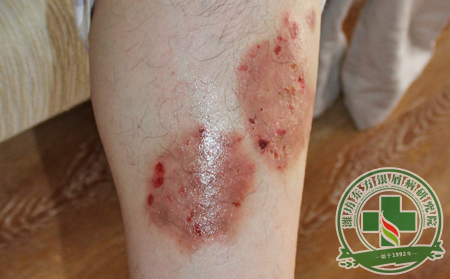 關(guān)節(jié)型銀屑病