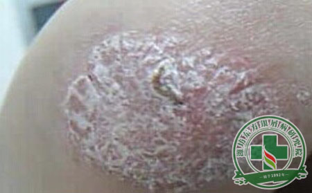 各年齡段的銀屑病患者受到了什么影響？