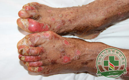 關節(jié)受損的銀屑病患者怎么自保？