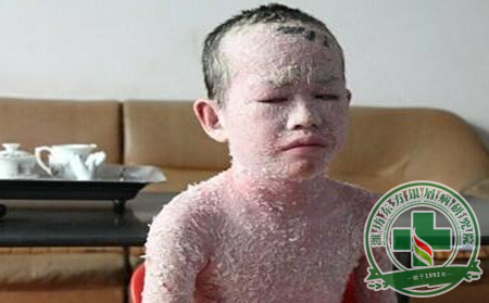 孩子為什么會得銀屑病呢？