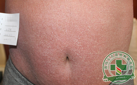 引發銀屑病的誘因博大廣遠