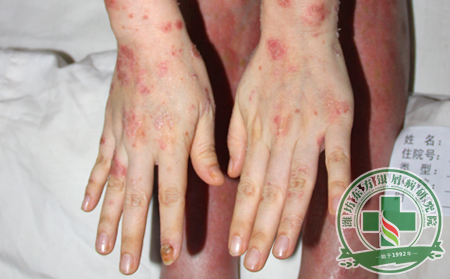銀屑病治療