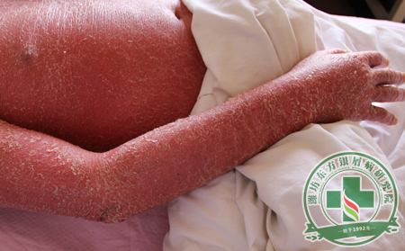 紅皮型銀屑病癥狀的仔細辨別方式