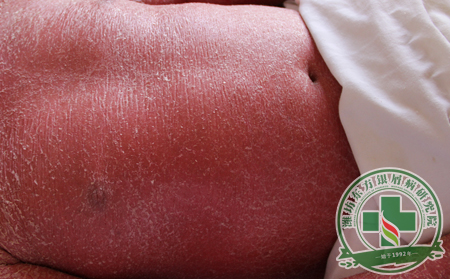 紅皮病型銀屑病