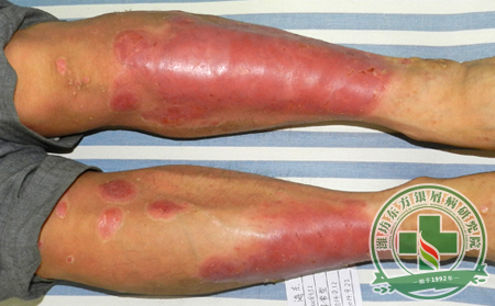 為什么紅皮型銀屑病患者會任由病情發展至此