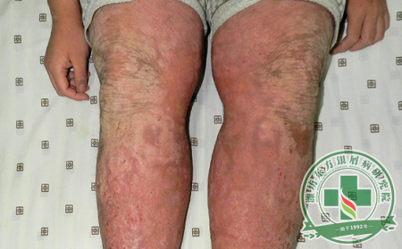 誘使銀屑病再次產(chǎn)生的根源著眼點(diǎn)在哪兒