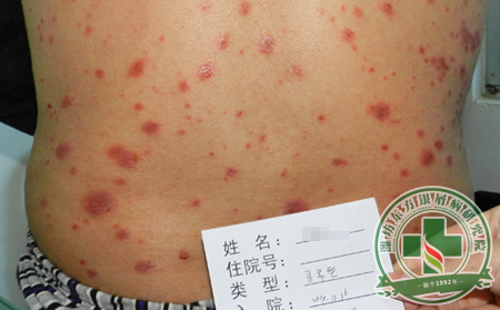 尋常型銀屑病患者遇到上火問題怎么解決損失小