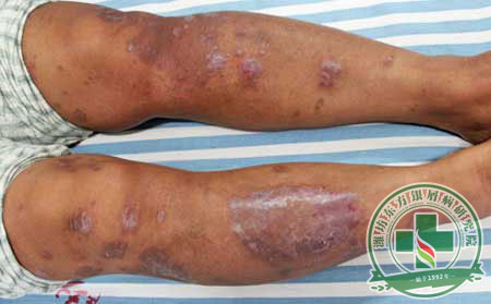 季節性銀屑病預防護理