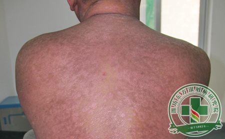 如何在治療銀屑病的同時給身體建立保護屏障