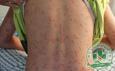 沒感冒也沒過敏，怎么得的銀屑病