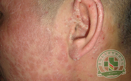 銀屑病護(hù)理