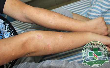 有沒有方法能夠避免尋常型銀屑病興風作浪