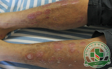 怎樣實現銀屑病的全面滲透性治療?