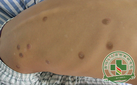 造福患者：怎樣將多種治療銀屑病的方法融會貫通