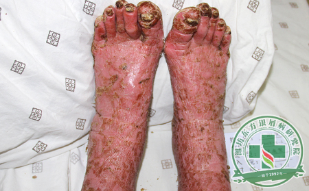 如何讓關(guān)節(jié)型銀屑病患者感受到身體復(fù)蘇趨勢