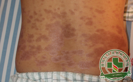 亂花迷人眼：怎樣挑選適合自己的銀屑病治療方法