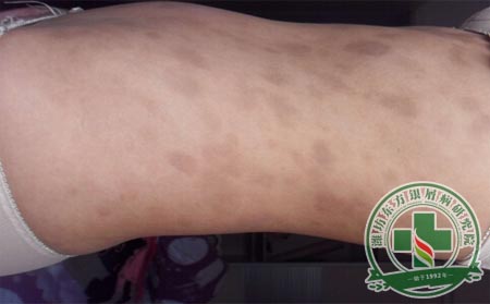 患者從哪些方面可以看出銀屑病已進(jìn)入消退期