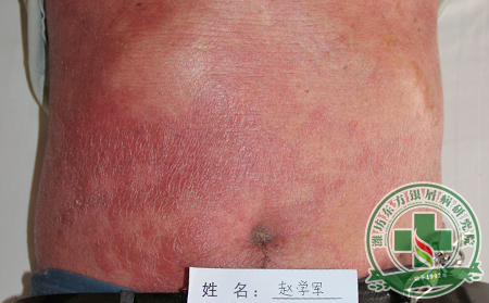 給銀屑病患者的中肯治療建議是什么