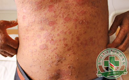 皮膚病患者初得尋常型銀屑病的癥狀