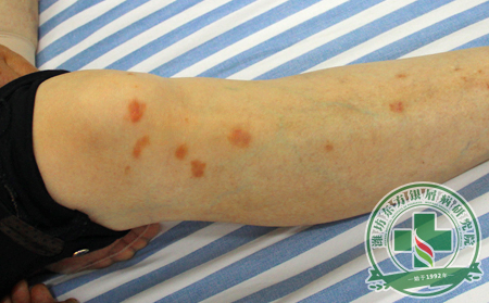 哪些方法能將銀屑病被誘發的概率降至更低