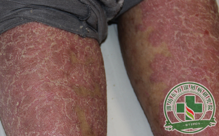 三分鐘秒懂紅皮型銀屑病的病癥動態